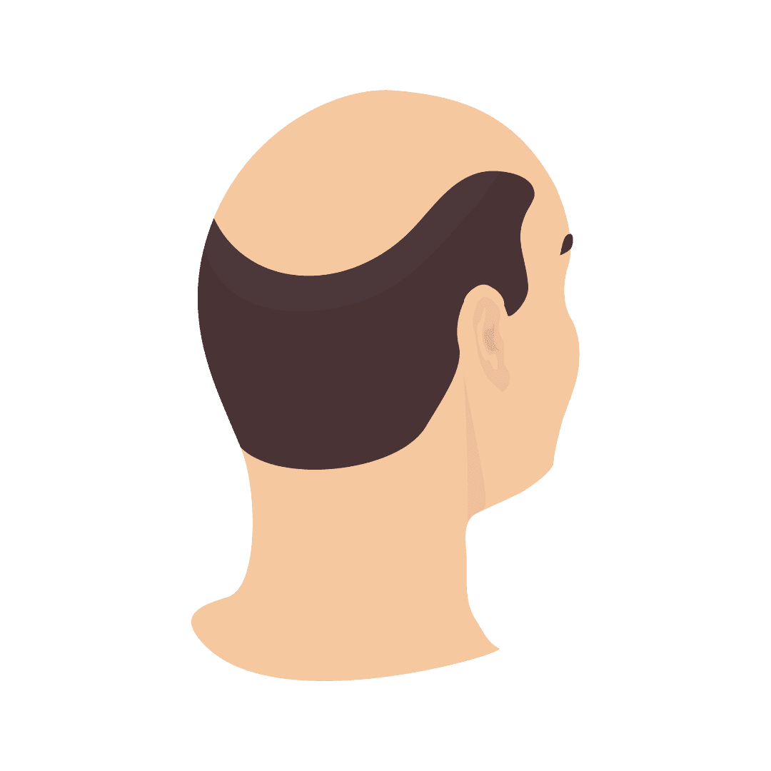Alopecia (baldness, hair loss)