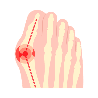Valgus deformity (ossicle on the foot)